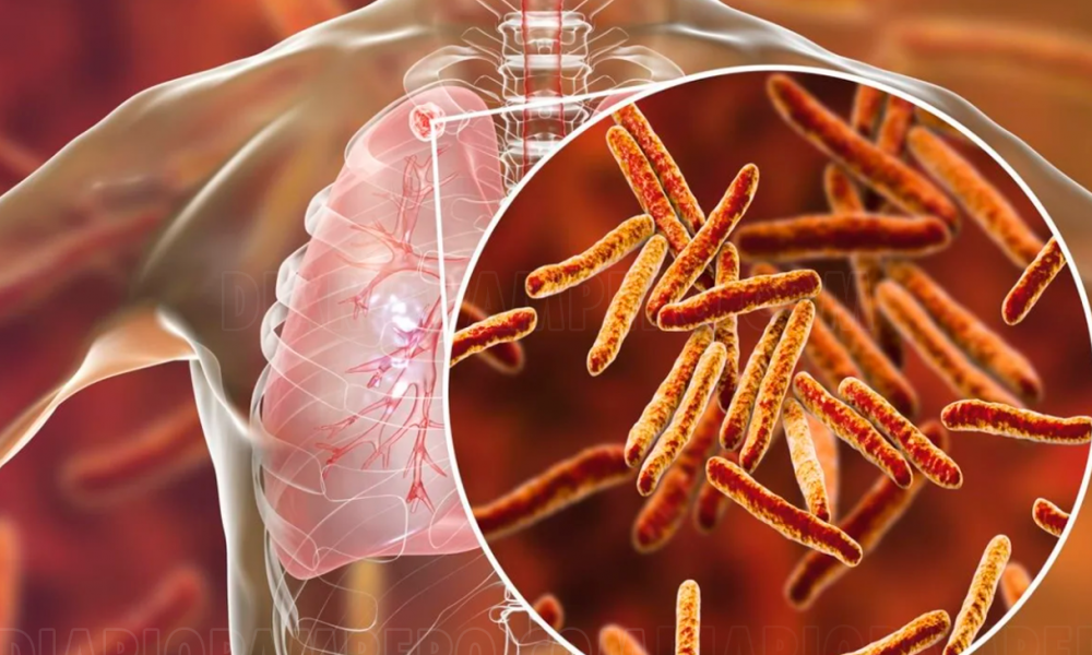 Tuberculosis post pandemia deja más de 4 mil fallecidos diariamente SALUD