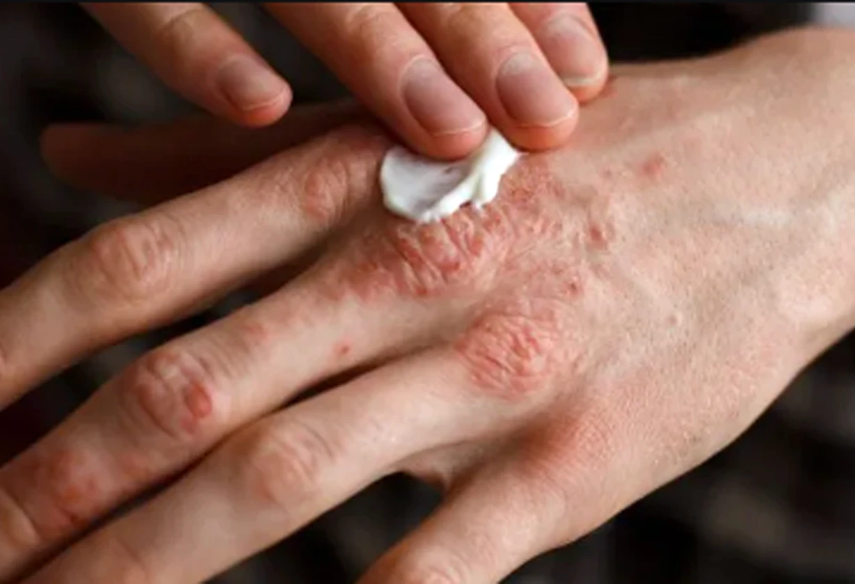 psoriasis