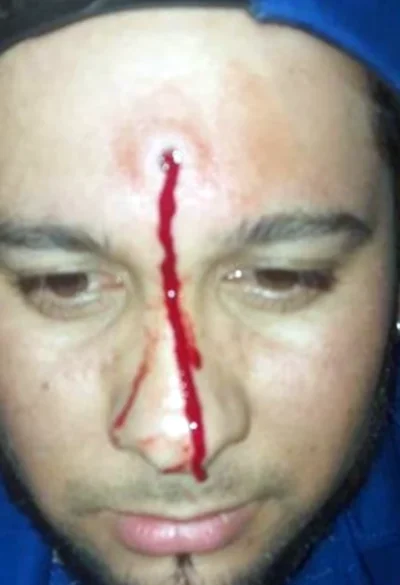 Le dispararon con un aire comprimido a un cantante de cumbia durante un show callejero